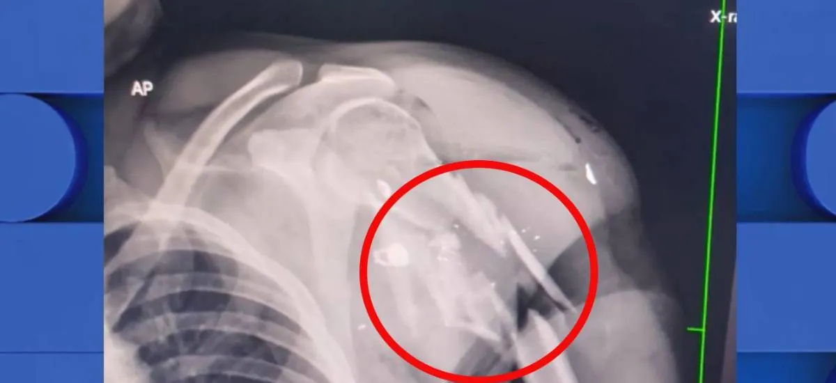 Hombre que fue sacado de una clínica tiene una fractura en el hombro producto de un disparo